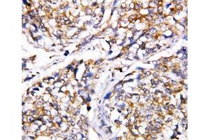 IHC-P: Caspase-4 antibody testing of human breast cancer tissue (Caspase 4 Antikörper  (AA 104-124))