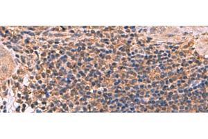 Immunohistochemistry of paraffin-embedded Human cervical cancer tissue using ZBTB33 Polyclonal Antibody at dilution of 1:30(x200)