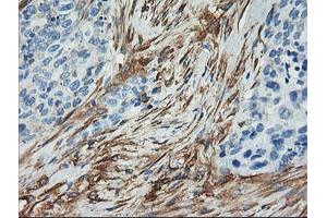 Immunohistochemical staining of paraffin-embedded Adenocarcinoma of Human breast tissue using anti-CNN2 mouse monoclonal antibody.