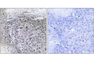 Immunohistochemistry analysis of paraffin-embedded human breast carcinoma tissue, using ZMY11 Antibody. (ZMYND11 Antikörper  (AA 111-160))