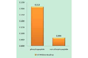 Immunohistochemistry analysis of paraffin-embedded human breast carcinoma tissue using Girdin (Phospho-Ser1417) antibody. (Girdin Antikörper  (pSer1417))