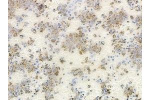 ABIN6261347 and ABIN6278392 at 1/100 staining human melanoma by IHC-P.