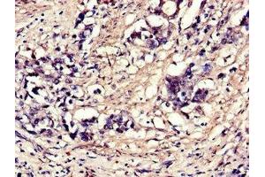 Immunohistochemistry of paraffin-embedded human gastric cancer using ABIN7152114 at dilution of 1:100 (EIF4A3 Antikörper  (AA 6-166))