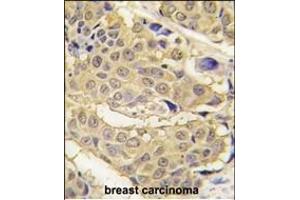 Formalin-fixed and paraffin-embedded human breast carcinoma tissue reacted with EPRS antibody (N-term) (ABIN391816 and ABIN2841664) , which was peroxidase-conjugated to the secondary antibody, followed by DAB staining. (EPRS Antikörper  (N-Term))