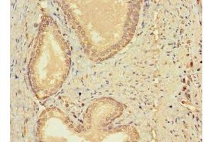 Immunohistochemistry of paraffin-embedded human prostate cancer using ABIN7147459 at dilution of 1:100 (CERKL Antikörper  (AA 1-558))