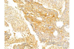 FAM92A1 Antibody at 1/100 staining Human lung cancer by IHC-P. (FAM92A1 Antikörper  (C-Term))