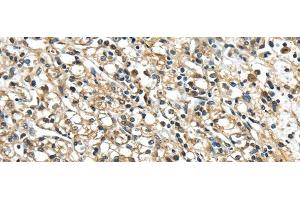 Immunohistochemistry of paraffin-embedded Human prostate cancer using NME2 Polyclonal Antibody at dilution of 1/40 (NME2 Antikörper)