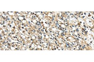 Immunohistochemistry of paraffin-embedded Human prostate cancer using NME2 Polyclonal Antibody at dilution of 1/40 (NME2 Antikörper)