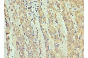 Immunohistochemistry of paraffin-embedded human colon cancer using ABIN7171070 at dilution of 1:100 (SMARCB1 Antikörper  (AA 86-385))