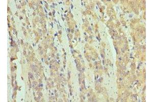 Immunohistochemistry of paraffin-embedded human colon cancer using ABIN7171070 at dilution of 1:100 (SMARCB1 Antikörper  (AA 86-385))