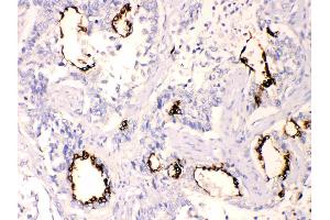 Anterior Gradient 2 was detected in paraffin-embedded sections of  human lung cancer tissues using rabbit anti- Anterior Gradient 2 Antigen Affinity purified polyclonal antibody (Catalog # ) at 1 µg/mL. (AGR2 Antikörper  (AA 21-175))