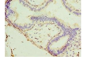 Immunohistochemistry of paraffin-embedded human breast cancer using ABIN7171226 at dilution of 1:100 (Syntaxin 11 Antikörper  (AA 1-287))