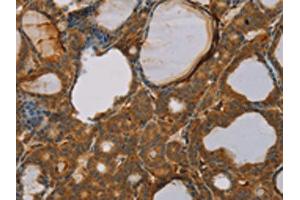 The image on the left is immunohistochemistry of paraffin-embedded Human thyroid cancer tissue using ABIN7130527(PAGE2 Antibody) at dilution 1/20, on the right is treated with fusion protein. (PAGE2 Antikörper)