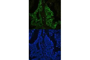 IF analysis of CTBP2 using anti-CTBP2 antibody (ABIN3042768) CTBP2 was detected in paraffin-embedded section of human colon cancer tissues.