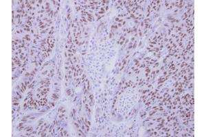 IHC-P Image Immunohistochemical analysis of paraffin-embedded human colon carcinoma, using BS69 antibody, antibody at 1:250 dilution. (ZMYND11 Antikörper)