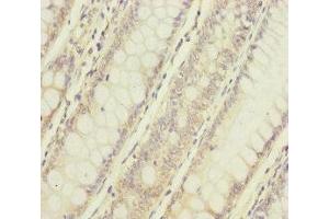 Immunohistochemistry of paraffin-embedded human colon cancer using ABIN7160738 at dilution of 1:100 (NAA25 Antikörper  (AA 703-972))