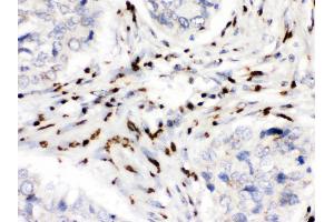 MDMX was detected in paraffin-embedded sections of human lung cancer tissues using rabbit anti- MDMX Antigen Affinity purified polyclonal antibody at 1 μg/mL. (MDM4-binding Protein Antikörper  (N-Term))