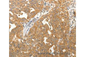 Immunohistochemistry of Human lung cancer using MAP1B  Polyclonal Antibody at dilution of 1:40 (MAP1B Antikörper)