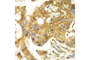 Immunohistochemistry of paraffin-embedded human liver cancer using CAPNS1 antibody. (Calpain S1 Antikörper  (AA 69-268))