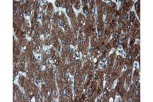 Immunohistochemical staining of paraffin-embedded Adenocarcinoma of endometrium tissue using anti-FAHD2A mouse monoclonal antibody. (FAHD2A Antikörper)