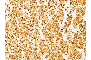 Formalin-fixed, paraffin-embedded human Melanoma stained with Melan-A / MART-1 Mouse Monoclonal Antibody (DT101 + BC199). (MLANA Antikörper)
