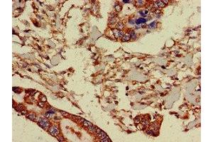 Immunohistochemistry of paraffin-embedded human pancreatic cancer using ABIN7164763 at dilution of 1:100 (PRR11 Antikörper  (AA 1-360))