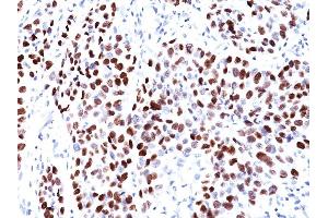 Formalin-fixed, paraffin-embedded human Lung SqCC stained with p21 Mouse Monoclonal Antibody (CIP1/823). (p21 Antikörper)
