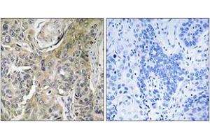 Immunohistochemistry analysis of paraffin-embedded human lung carcinoma tissue, using RHOBTB3 Antibody. (RHOBTB3 Antikörper  (AA 335-384))
