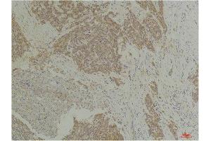 Immunohistochemistry (IHC) analysis of paraffin-embedded Human Breast Carcinoma using CLIC4 Rabbit Polyclonal Antibody diluted at 1:200. (CLIC4 Antikörper)