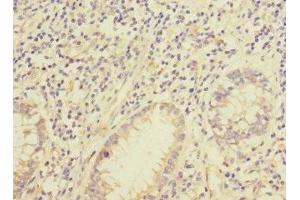Immunohistochemistry of paraffin-embedded human colon cancer using ABIN7157030 at dilution of 1:100