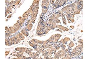 The image on the left is immunohistochemistry of paraffin-embedded Human esophagus cancer tissue using ABIN7127988(PPIL1 Antibody) at dilution 1/30, on the right is treated with fusion protein. (PPIL1 Antikörper)