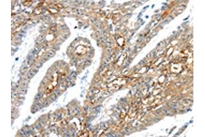 The image on the left is immunohistochemistry of paraffin-embedded Human esophagus cancer tissue using ABIN7192909(TRIM47 Antibody) at dilution 1/30, on the right is treated with synthetic peptide. (TRIM47 Antikörper)