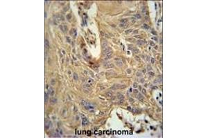 IL5RA Antibody (N-term) (ABIN651428 and ABIN2840234) immunohistochemistry analysis in formalin fixed and paraffin embedded human lung carcinoma followed by peroxidase conjugation of the secondary antibody and DAB staining.