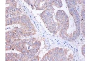 Immunohistochemistry of paraffin-embedded human colon cancer using ABIN7144373 at dilution of 1:100 (AP2S1 Antikörper  (AA 1-142))