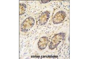 Formalin-fixed and paraffin-embedded human colon carcinoma tissue reacted with AKR1B1 antibody (C-term) (ABIN389205 and ABIN2839363) , which was peroxidase-conjugated to the secondary antibody, followed by DAB staining.