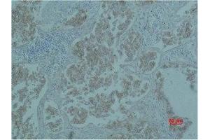 Immunohistochemical analysis of paraffin-embedded Human Lung caricnoma using Catenin-β Monoclonal Antibody.