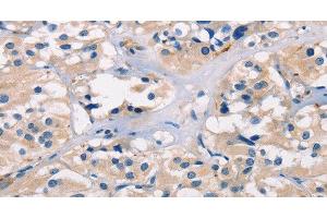 Immunohistochemistry of paraffin-embedded Human thyroid cancer tissue using ADGRB1 Polyclonal Antibody at dilution 1:40