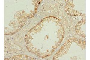 Immunohistochemistry of paraffin-embedded human prostate cancer using ABIN7146273 at dilution of 1:100 (Calcineurin B Antikörper  (AA 1-170))