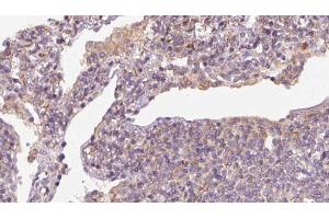 ABIN6273163 at 1/100 staining Human lymph cancer tissue by IHC-P. (SLC38A3 Antikörper  (Internal Region))