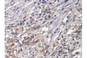 DAB staining on IHC-P; Samples: Human Ovarian cancer Tissue
