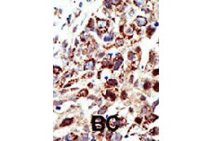 Formalin-fixed and paraffin-embedded human cancer tissue reacted with STAM polyclonal antibody  , which was peroxidase-conjugated to the secondary antibody, followed by AEC staining. (STAM Antikörper  (C-Term))