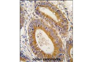 Formalin-fixed and paraffin-embedded human colon carcinoma tissue reacted with YARS2 antibody , which was peroxidase-conjugated to the secondary antibody, followed by DAB staining.