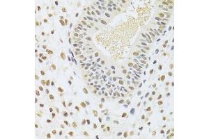 Immunohistochemistry of paraffin-embedded human uterine cancer using DDB1 Antibody. (DDB1 Antikörper)