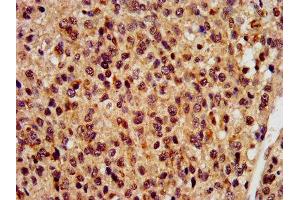 IHC image of ABIN7168275 diluted at 1:400 and staining in paraffin-embedded human glioma performed on a Leica BondTM system. (RBM9 Antikörper  (AA 8-110))