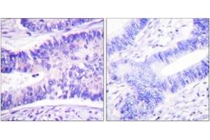 Immunohistochemistry analysis of paraffin-embedded human colon carcinoma, using WAVE1 (Phospho-Tyr125) Antibody. (WASF1 Antikörper  (pTyr125))