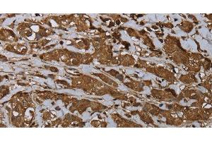 Immunohistochemistry of paraffin-embedded Human breast cancer using ARHGDIA Polyclonal Antibody at dilution of 1:30 (ARHGDIA Antikörper)