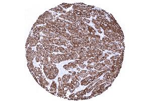 Squamous cell carcinoma of the uterine cervix with strong Cytokeratin 6 positivity (Rekombinanter Keratin 6 Antikörper)