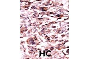 Formalin-fixed and paraffin-embedded human hepatocellular carcinoma tissue reacted with ABL1 (phospho Y245) polyclonal antibody  which was peroxidase-conjugated to the secondary antibody followed by AEC staining. (ABL1 Antikörper  (pTyr245))