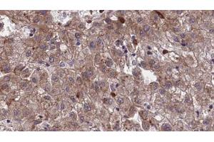 ABIN6273968 at 1/100 staining Human liver cancer tissue by IHC-P. (OR1I1 Antikörper  (C-Term))