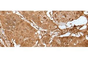 Immunohistochemistry of paraffin-embedded Human esophagus cancer tissue using LIPG Polyclonal Antibody at dilution of 1:50(x200) (LIPG Antikörper)